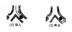 完全性阻塞型(引起肺不张)