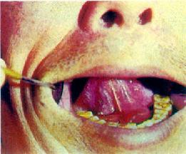 第六节 常见的口腔颌面部肿瘤(tumors of oral and
